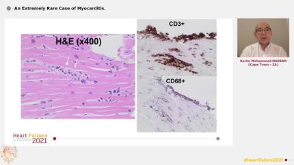An Extremely Rare Case of Myocarditis.