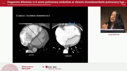 Diagnostic dilemma: is it acute pulmonary embolism or chronic thromboembolic pulmonary hypertension?