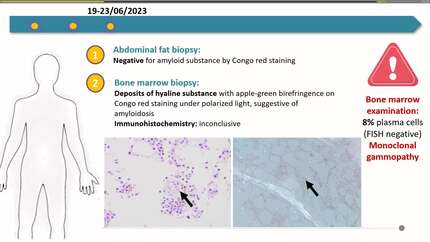 Amyloidosis – what to look for?