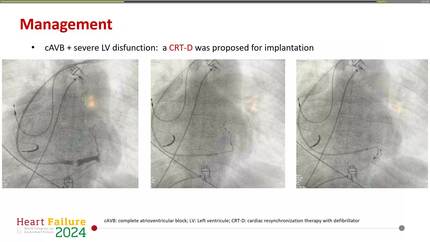 A complex case of CRT implantation in a congenitally corrected transposition of great vessels