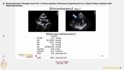 Haemodynamic Changes from Pre- to Post-capillary Pulmonary Hypertension  in a Heart Failure Patient with Hyperthyroidism.