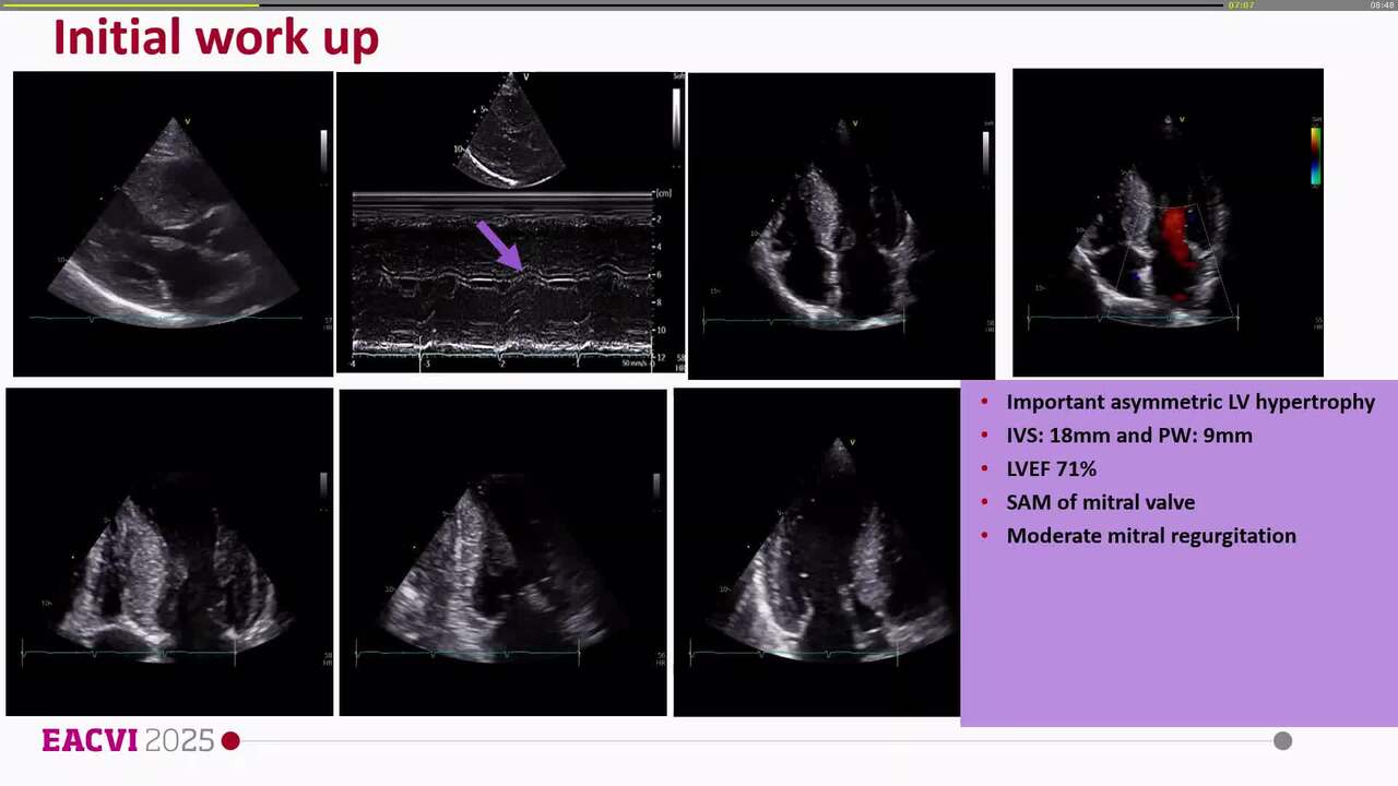 Cardiomyopathies cases