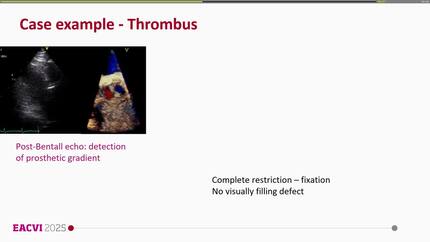 Cardiac CT to evaluate prosthetic valve thrombus and pannus