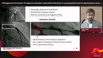 Spontaneous coronary artery dissection 