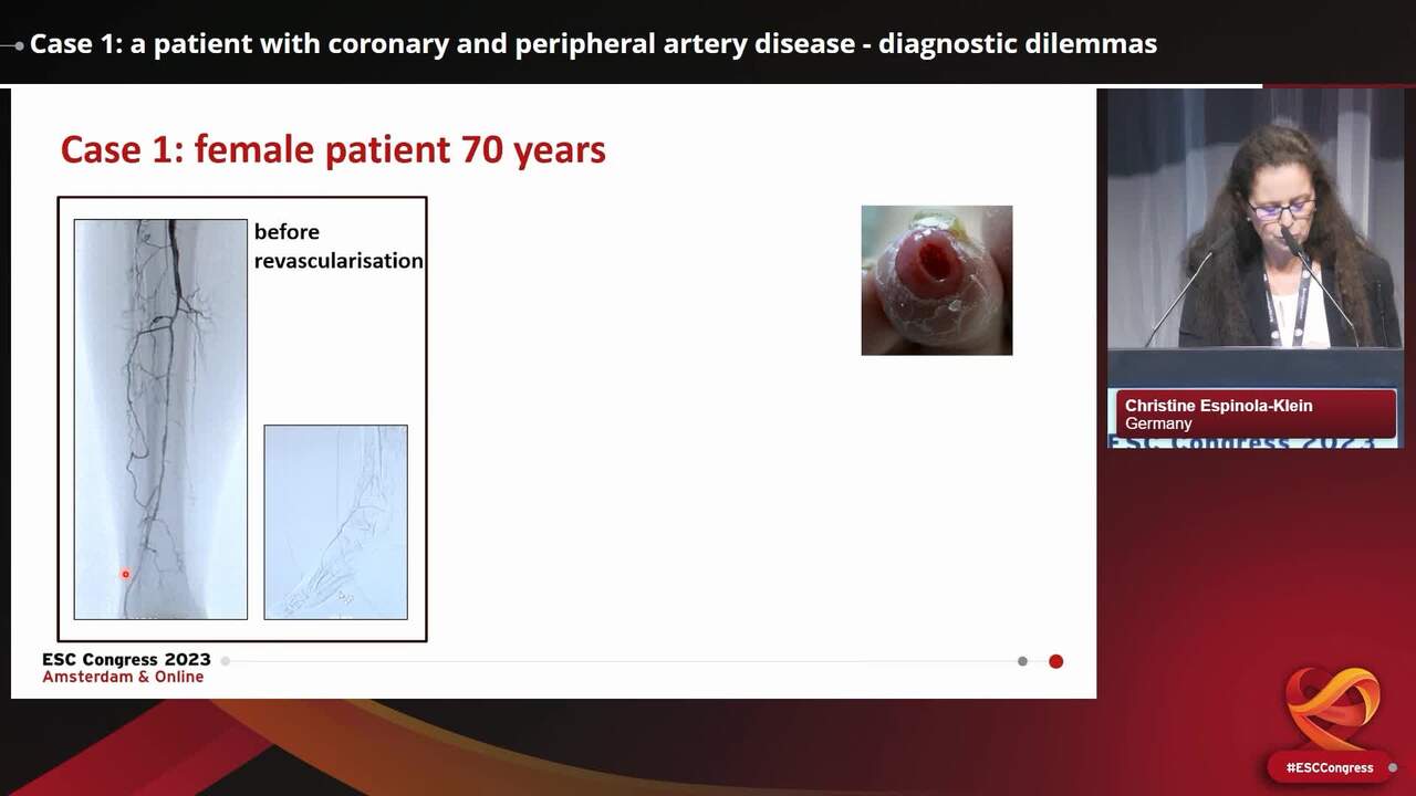 Case 1: a patient with coronary and peripheral artery disease - diagnostic dilemmas