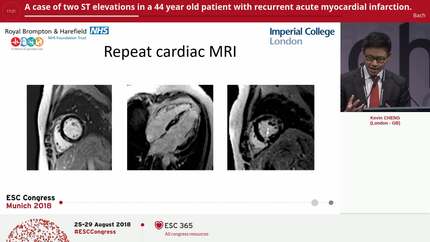 A case of two ST elevations in a 44 year old patient with recurrent acute myocardial infarction.