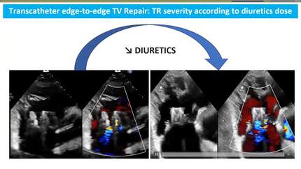 How to assess patients after transcatheter valve procedures