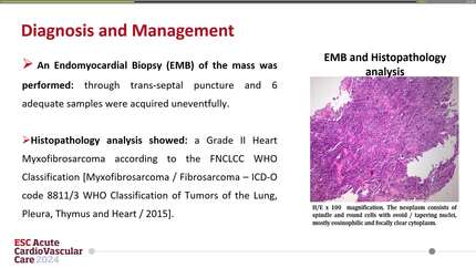 Fibrosarcoma presenting as acute left ventricular outflow tract obstruction: all that glitters is not always gold, is it?