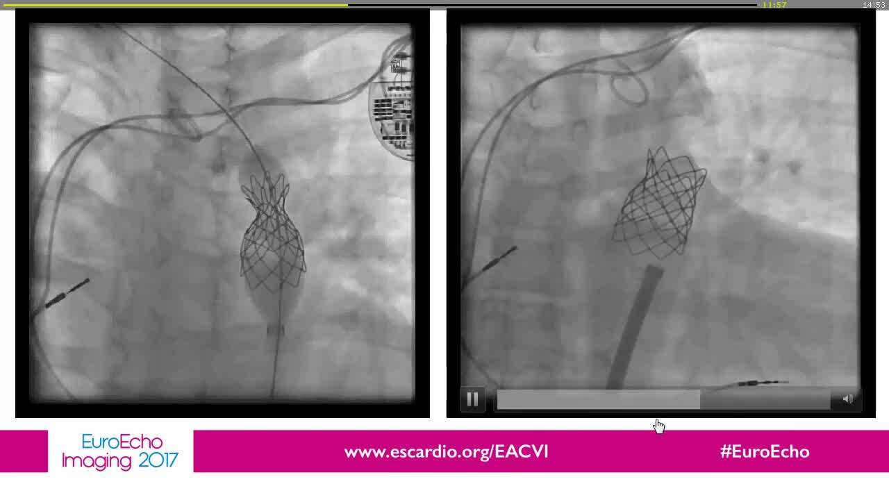 Pitfalls in quantifying aortic valve regurgitation in case of bicuspid valve.