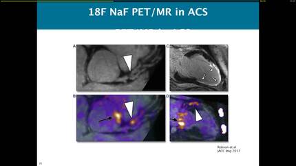 Looking at coronary plaque biology with PET?