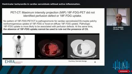 Ventricular tachycardia in cardiac sarcoidosis without active inflammation.