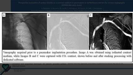 Prospective evaluation of carbon dioxide as a contrast medium in pacemakers or defibrillators carriers for venous angiography (SPARKLING pilot study)