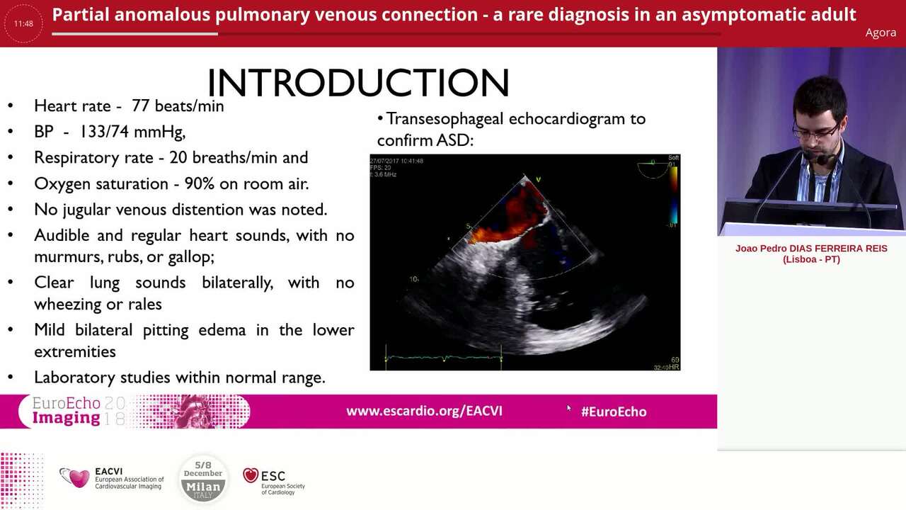 Partial anomalous pulmonary venous connection - a rare diagnosis in an asymptomatic adult 