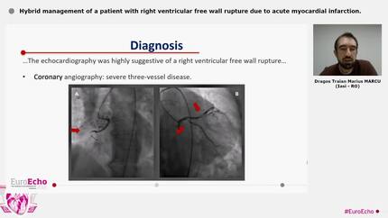 Hybrid management of a patient with right ventricular free wall rupture due to acute myocardial infarction.
