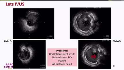 Jailbreak through stent struts: an off-label use of rotablation in major side branch occlusion