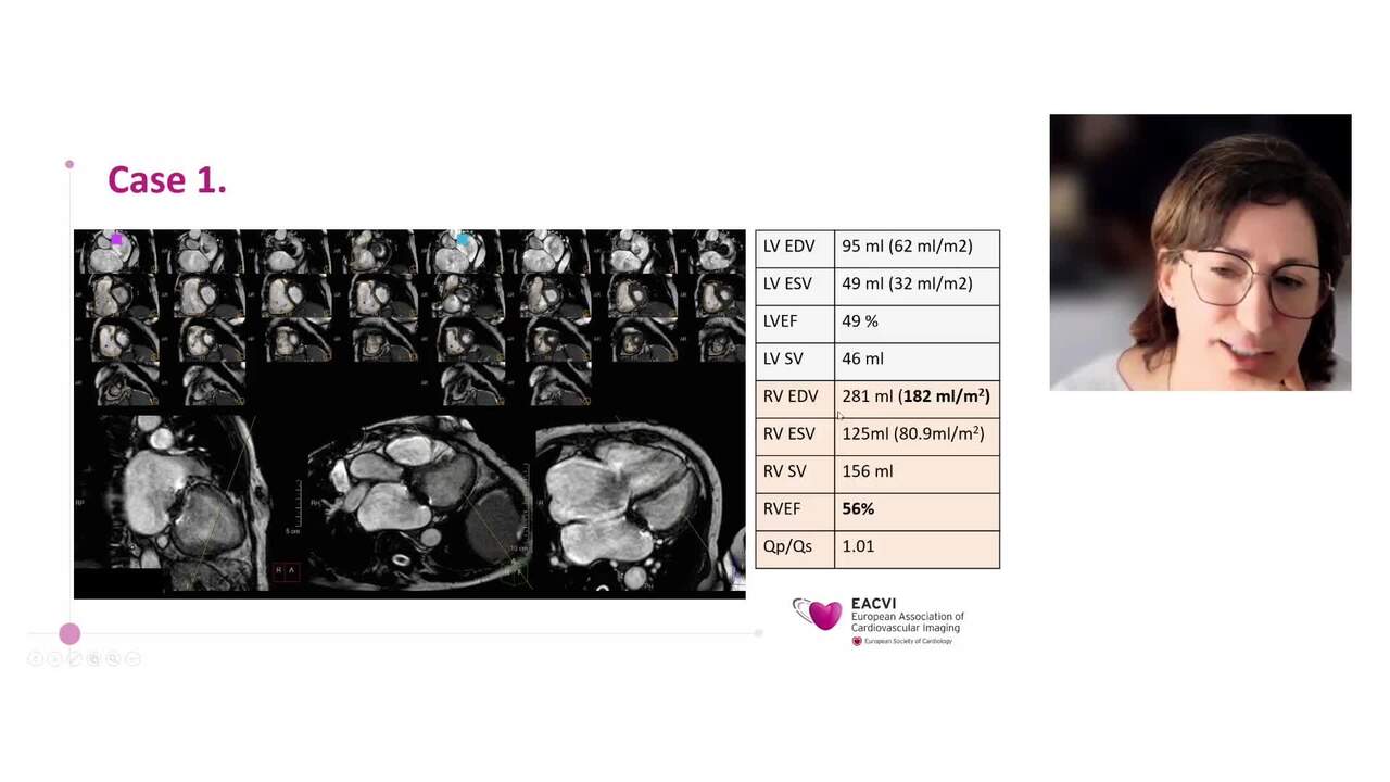 Tricuspid regurgitation: from diagnosis to transcatheter treatment in light of 2025 ESC Guidelines on Valvular Heart Disease