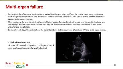 Sustained ventricular tachycardia - major clinical issue