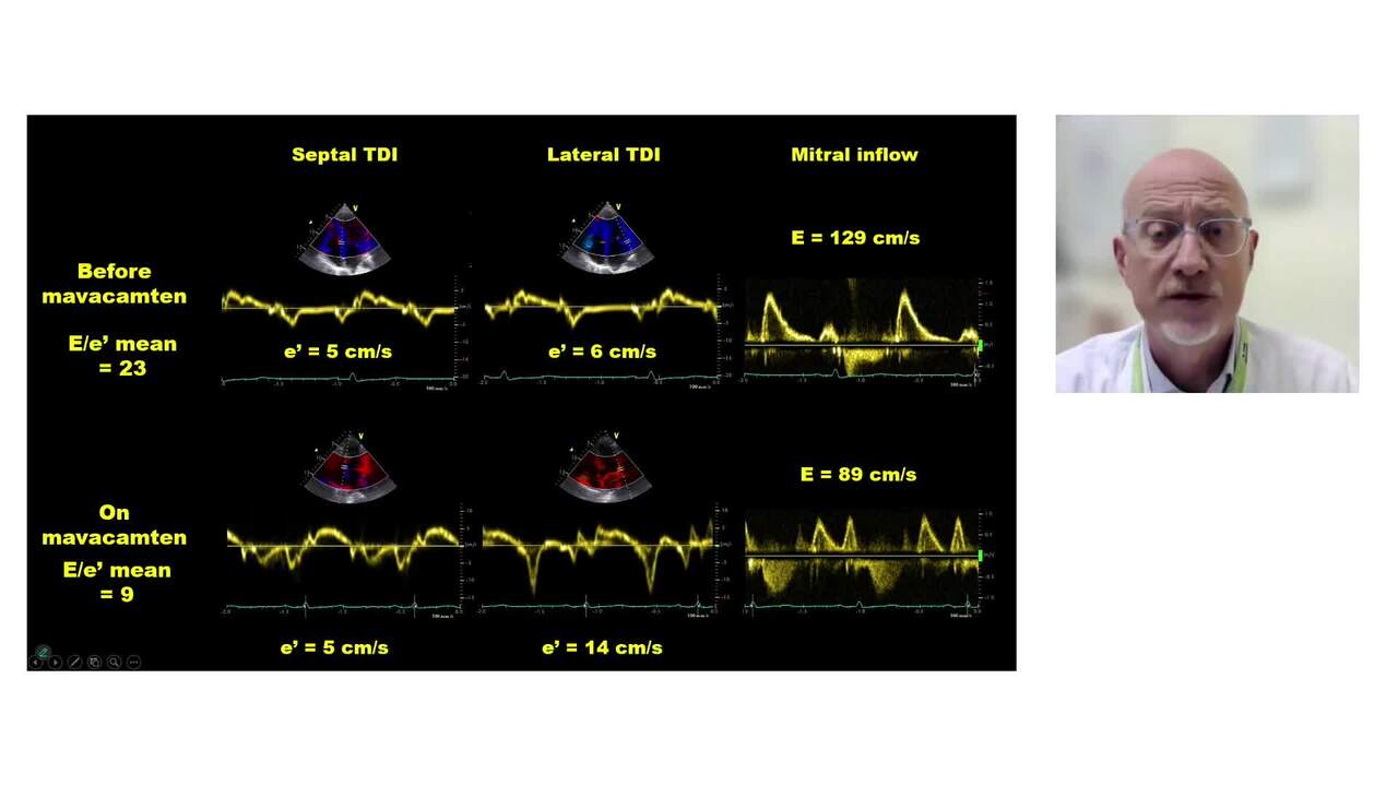 Innovative management of myocardial hypertrophy and hypertrophic (obstructive) cardiomyopathy