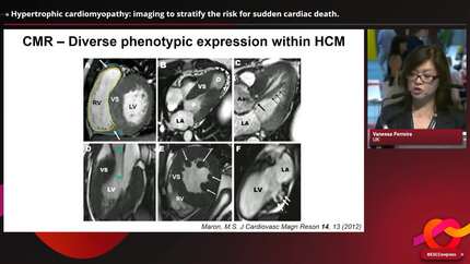 Meet the Experts: imaging to stratify for SCD risk in patients with cardiomyopathies: latest insights
