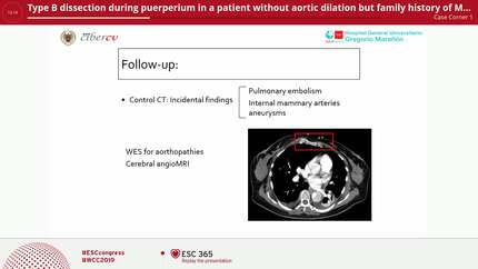 Type B dissection during puerperium in a patient without aortic dilation but family history of Marfan syndrome.