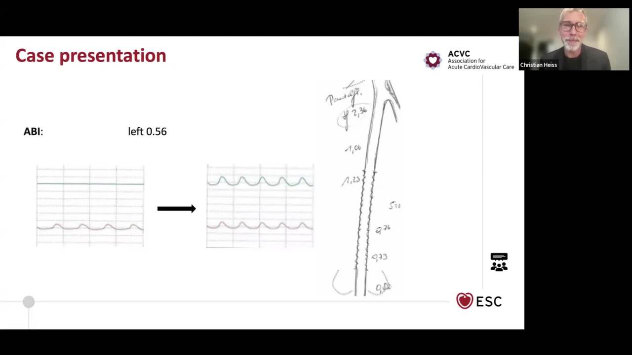 ACVC Talks - episode 4 - Acute Cardiovascular Thromboembolic Diseases