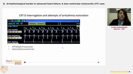 Arrhythmiological burden in advanced heart failure: A slow ventricular tachycardia (VT) case.