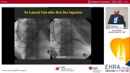 CRT implantation - The easy and the difficult case