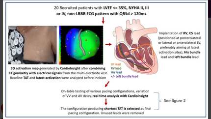 Personalized cardiac resynchronization therapy guided by real-time electrocardiographic imaging for non-left bundle branch block patients