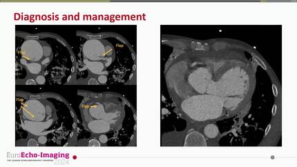 Optimization of imaging techniques, the key on the diagnosis of a type A aortic dissection.