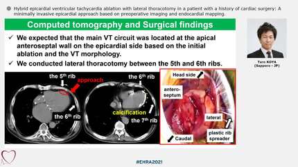 Hybrid epicardial ventricular tachycardia ablation with lateral thoracotomy in a patient with a history of cardiac surgery: A minimally invasive epicardial approach based on preoperative imaging and endocardial mapping.