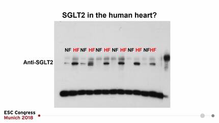 Empagliflozin potently reduces sarcoplasmic Ca leak and increases Ca transient amplitude of human failing ventricular cardiomyocytes