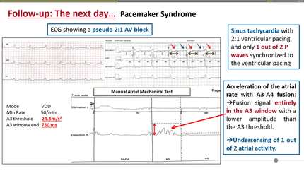 MICRA AV leadless system pacing: what a challenge for a new technology