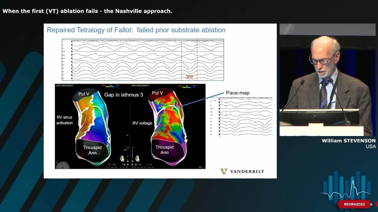 When the first (VT) ablation fails - the Nashville approach.