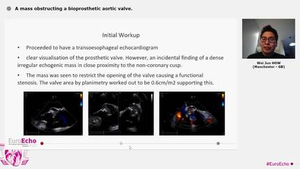 A mass obstructing a bioprosthetic aortic valve.
