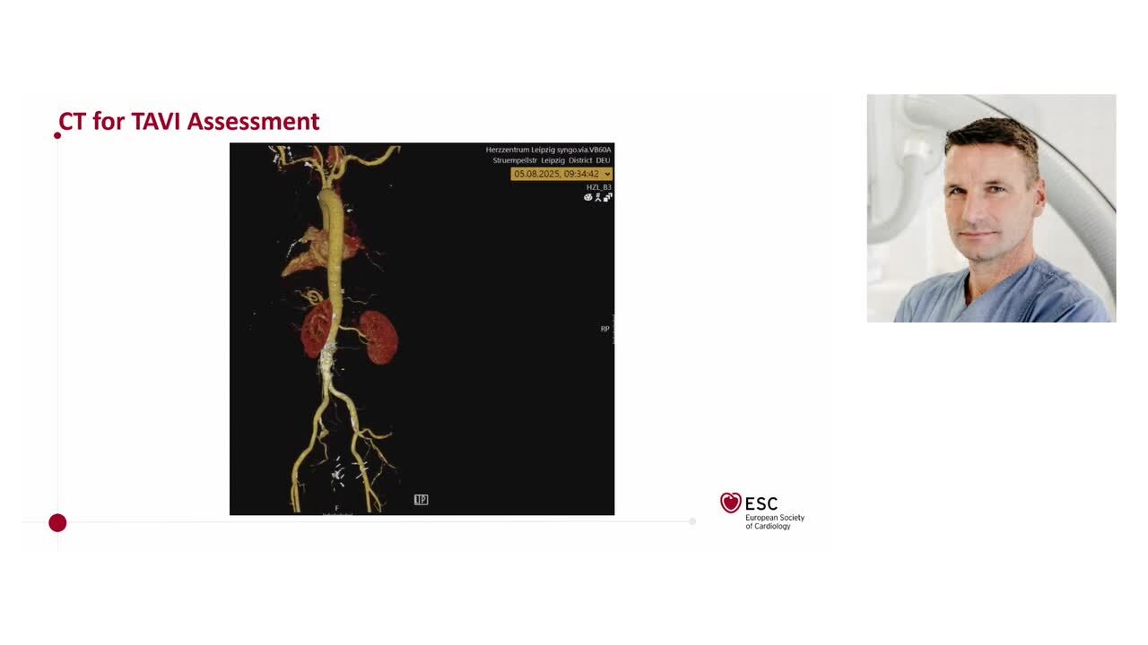 2025 ESC Guidelines on Valvular heart disease: what’s new in aortic stenosis