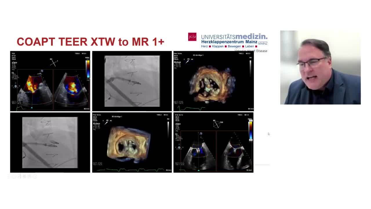 Mitral valve regurgitation management: what is new?