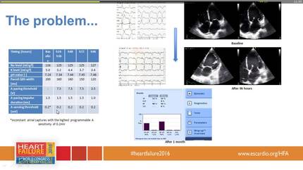 Hyponatremia- possible factor in biventricular pacing abnormalities