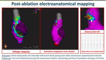 Pulsed-field ablation of a focal atrial tachycardia from the superior vena cava in proximity to the phrenic nerve