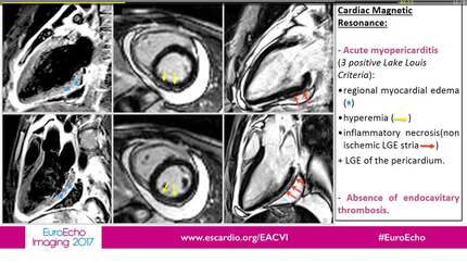 Left ventricular spontaneous echo contrast in a young patient with acute myocarditis complicated by cardioembolic stroke. When there's smoke there's fire?