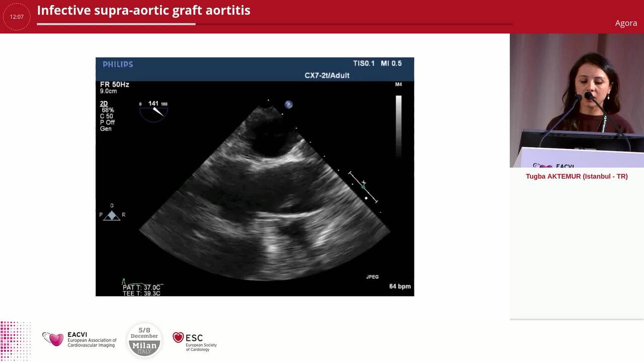 Infective supra-aortic graft aortitis