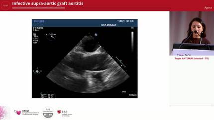 Infective supra-aortic graft aortitis