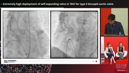 Extremely high deployment of self-expanding valve in TAVI for type 0 bicuspid aortic valve