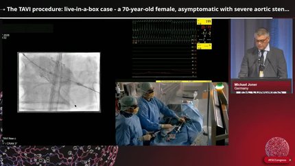 From referral to intervention for aortic stenosis: implementation of the 2025 ESC recommendations for younger and asymptomatic patients
