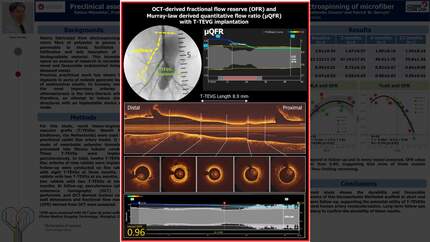 Preclinical assessment of transcatheter-delivered expandable endoluminal  polymeric graft fabricated by electrospinning of microfiber
