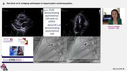 The thick of it; bridging aetiologies in hypertrophic cardiomyopathy
.