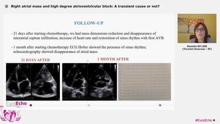 Right atrial mass and high degree atrioventricular block:  A transient cause or not?