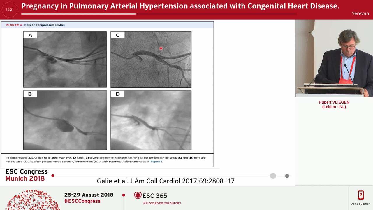 Pregnancy in Pulmonary Arterial Hypertension associated with Congenital Heart Disease.
