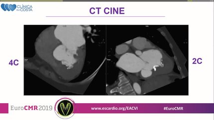 Apical hypertrophic cardiomyopathy, or not?