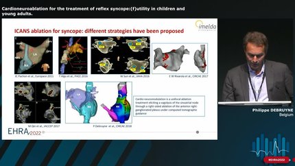 Cardioneuroablation for the treatment of reflex syncope:(f)utility in children and young adults.