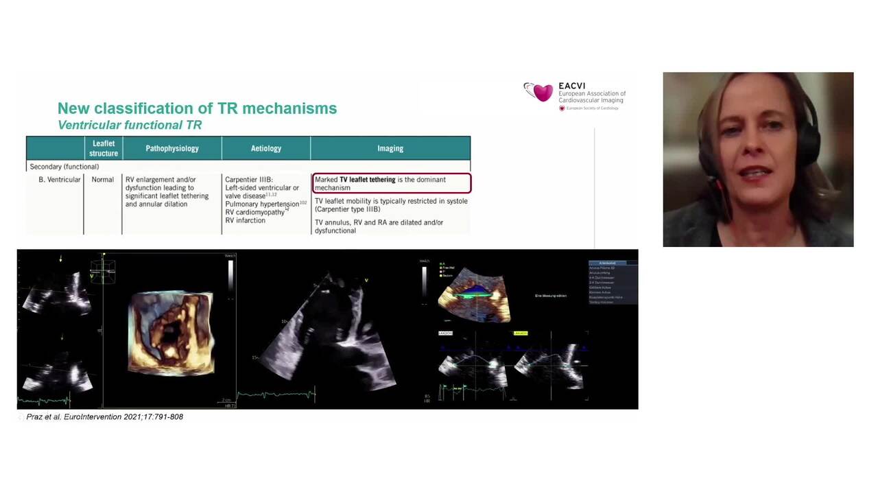 New vision of the tricuspid valve